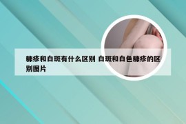 糠疹和白斑有什么区别 白斑和白色糠疹的区别图片