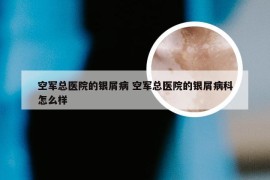 空军总医院的银屑病 空军总医院的银屑病科怎么样