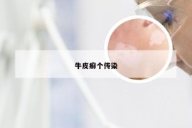 牛皮癣个传染