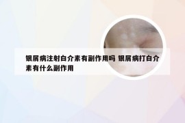 银屑病注射白介素有副作用吗 银屑病打白介素有什么副作用