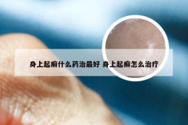 身上起癣什么药治最好 身上起癣怎么治疗