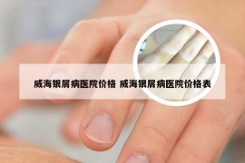 威海银屑病医院价格 威海银屑病医院价格表