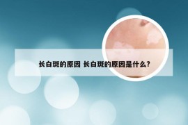 长白斑的原因 长白斑的原因是什么?