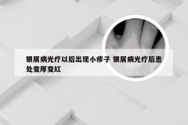 银屑病光疗以后出现小疹子 银屑病光疗后患处变厚变红