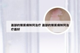 面部的银屑病如何治疗 面部的银屑病如何治疗最好