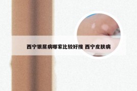 西宁银屑病哪家比较好搜 西宁皮肤病