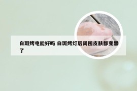 白斑烤电能好吗 白斑烤灯后周围皮肤都变黑了