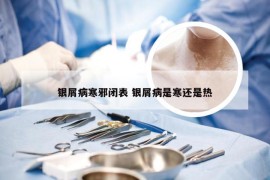 银屑病寒邪闭表 银屑病是寒还是热