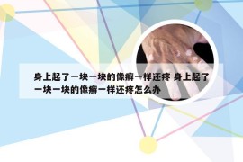身上起了一块一块的像癣一样还疼 身上起了一块一块的像癣一样还疼怎么办