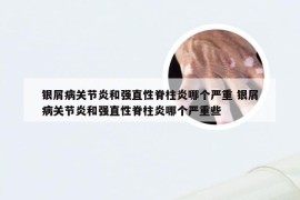 银屑病关节炎和强直性脊柱炎哪个严重 银屑病关节炎和强直性脊柱炎哪个严重些