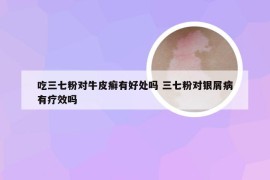 吃三七粉对牛皮癣有好处吗 三七粉对银屑病有疗效吗