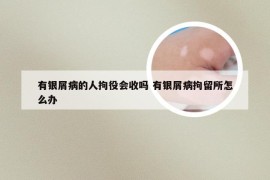 有银屑病的人拘役会收吗 有银屑病拘留所怎么办
