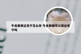 牛皮癣用达克宁怎么样 牛皮肤癣可以用达克宁吗