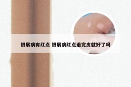银屑病有红点 银屑病红点退完皮就好了吗