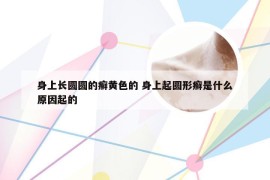 身上长圆圆的癣黄色的 身上起圆形癣是什么原因起的