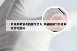 银屑病关节炎能用艾灸吗 银屑病关节炎能用艾灸吗图片