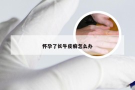 怀孕了长牛皮癣怎么办