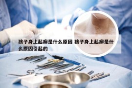 孩子身上起癣是什么原因 孩子身上起癣是什么原因引起的