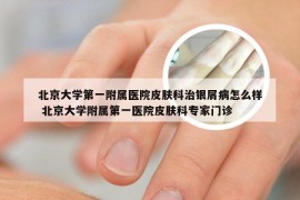 北京大学第一附属医院皮肤科治银屑病怎么样 北京大学附属第一医院皮肤科专家门诊