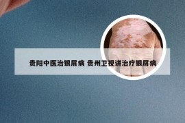 贵阳中医治银屑病 贵州卫视讲治疗银屑病