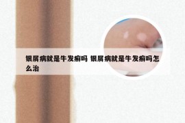 银屑病就是牛发癣吗 银屑病就是牛发癣吗怎么治