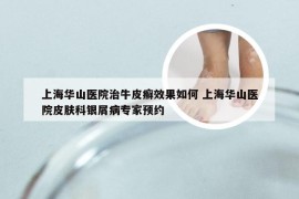上海华山医院治牛皮癣效果如何 上海华山医院皮肤科银屑病专家预约