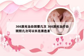 308激光治白斑要几次 308激光治疗白斑照几次可以长出黑色素