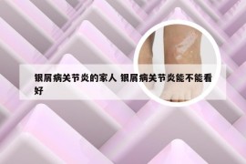 银屑病关节炎的家人 银屑病关节炎能不能看好