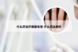 什么药治疗癣最有用 什么药冶癣好