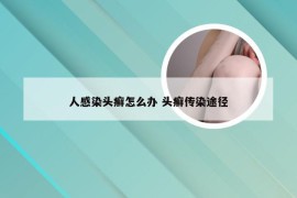人感染头癣怎么办 头癣传染途径