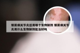 银屑病关节炎适用哪个生物制剂 银屑病关节炎用什么生物制剂能治好吗
