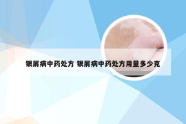 银屑病中药处方 银屑病中药处方用量多少克