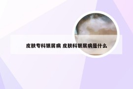 皮肤专科银屑病 皮肤科银屑病是什么