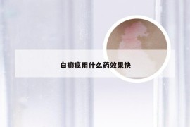 白癫疯用什么药效果快