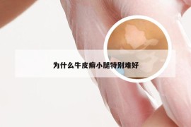 为什么牛皮癣小腿特别难好