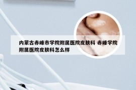内蒙古赤峰市学院附属医院皮肤科 赤峰学院附属医院皮肤科怎么样