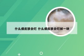 什么病皮肤会烂 什么病皮肤会烂掉一块