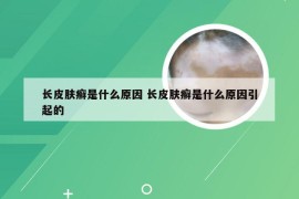 长皮肤癣是什么原因 长皮肤癣是什么原因引起的