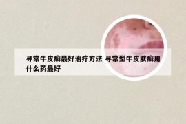 寻常牛皮癣最好治疗方法 寻常型牛皮肤癣用什么药最好