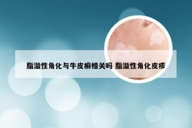 脂溢性角化与牛皮癣相关吗 脂溢性角化皮疹