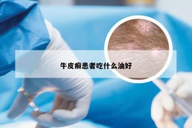 牛皮癣患者吃什么油好