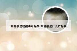 银屑病是啥病毒引起的 银屑病是什么严起的