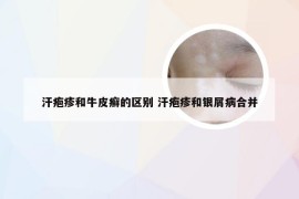 汗疱疹和牛皮癣的区别 汗疱疹和银屑病合并