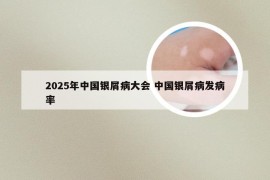 2025年中国银屑病大会 中国银屑病发病率