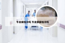 牛皮癣怕冷吗 牛皮肤癣怕冷吗