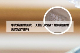 牛皮癣用香蕉皮一天擦几次最好 银屑病用香蕉皮起作用吗