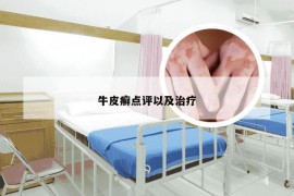 牛皮癣点评以及治疗