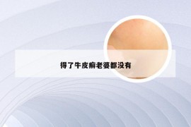 得了牛皮癣老婆都没有