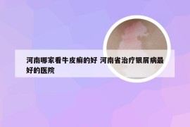 河南哪家看牛皮癣的好 河南省治疗银屑病最好的医院