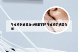 牛皮癣到底是身体哪里不好 牛皮癣的病因在哪